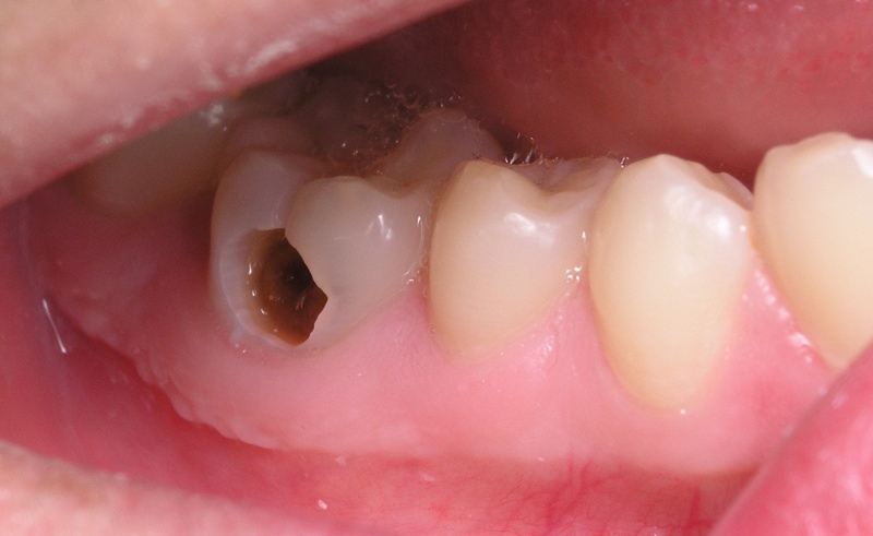 Dự phòng bệnh sâu răng ở trẻ em